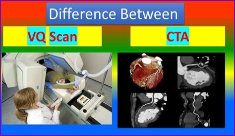 Can VQ scan diagnose PE?